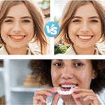 CARILLAS DENTALES Snap-On Smile