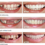 CARILLAS DENTALES Snap-On Smile