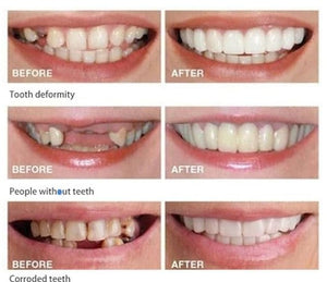 CARILLAS DENTALES Snap-On Smile
