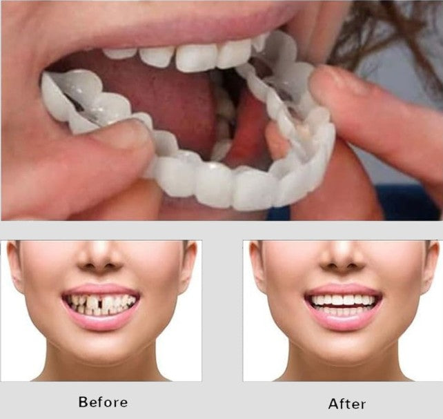 CARILLAS DENTALES Snap-On Smile