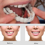 CARILLAS DENTALES Snap-On Smile