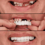 CARILLAS DENTALES Snap-On Smile