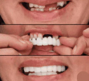 CARILLAS DENTALES Snap-On Smile